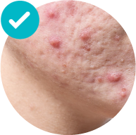 curanta abscesos